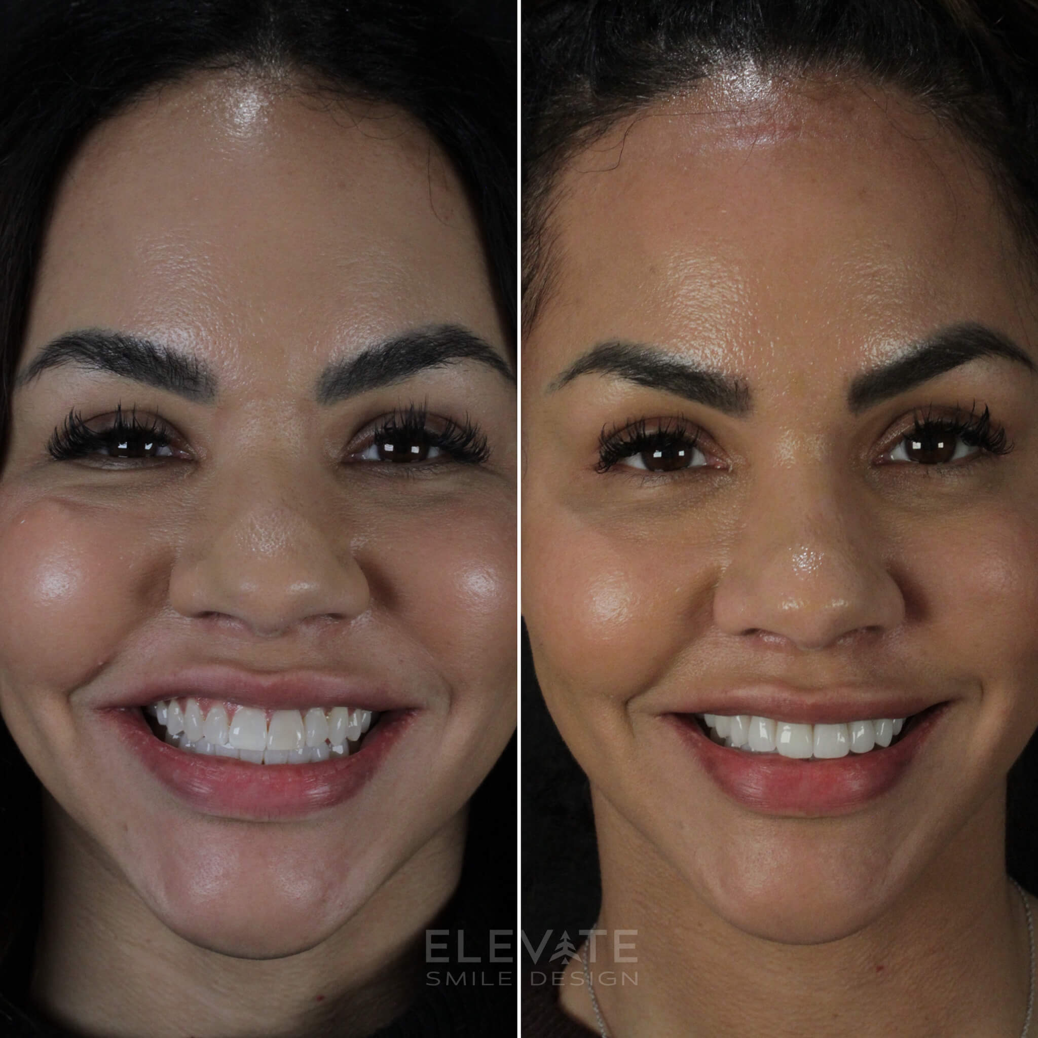 before/after smile transformation