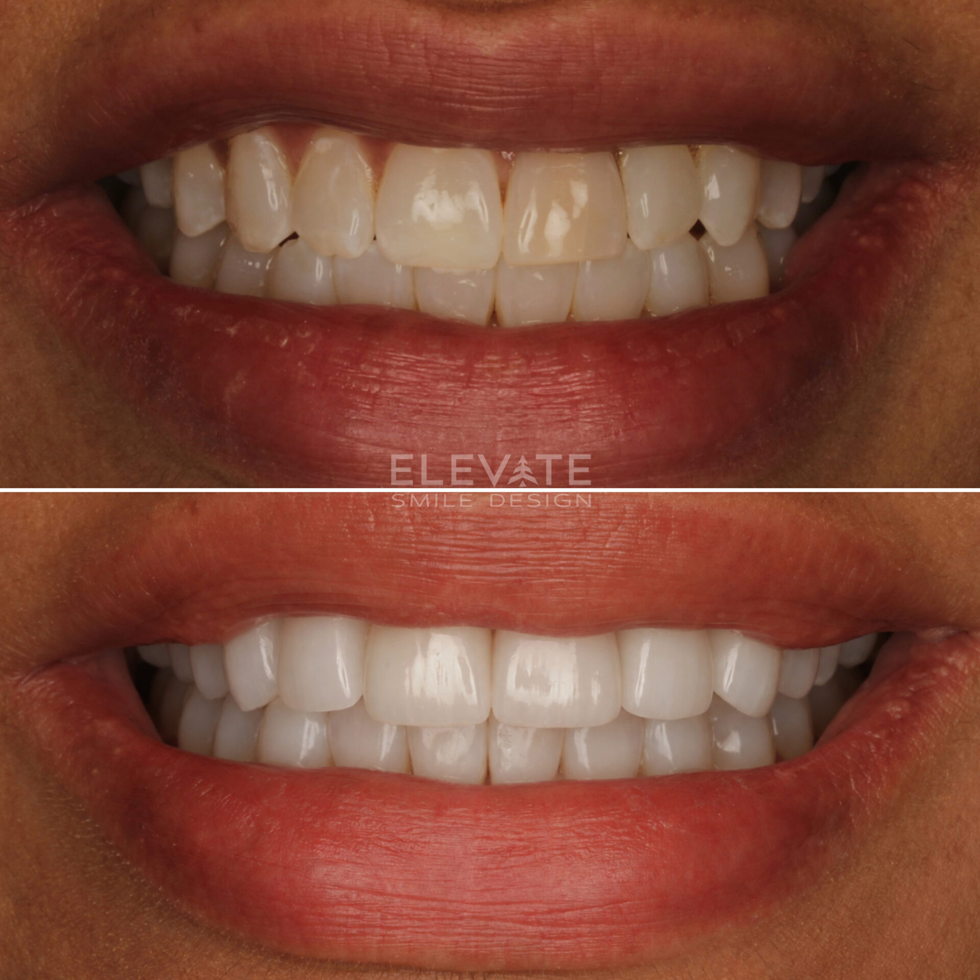 before/after smile transformation