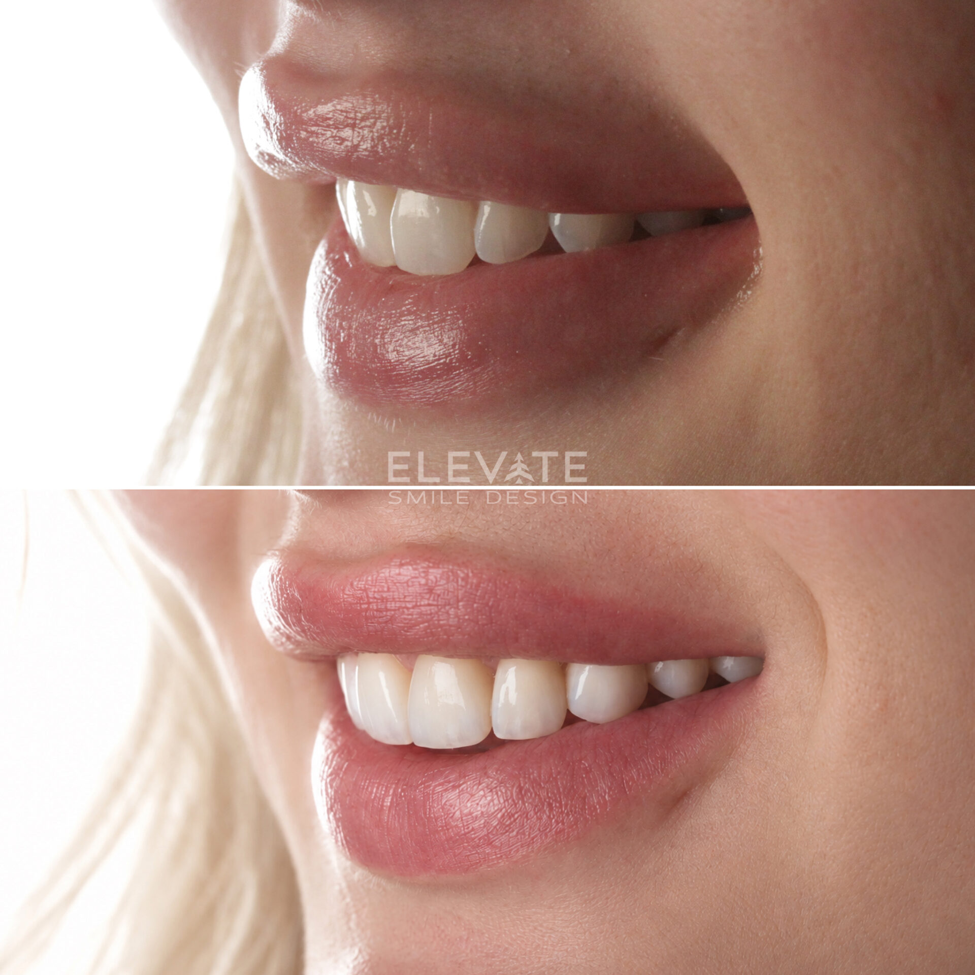 before/after smile transformation